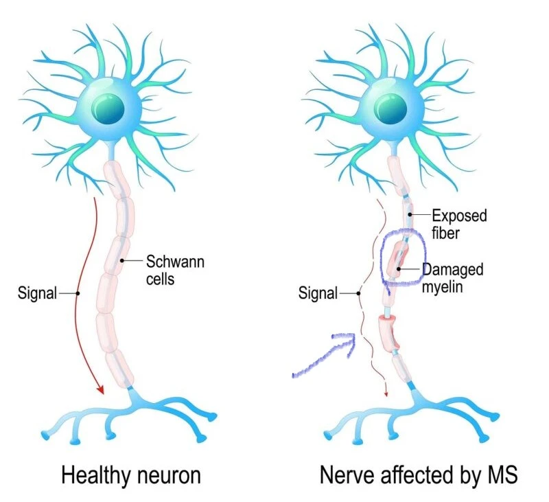 Multiple Sclerosis | Types | Symptoms | Diagnosis - Mission Education